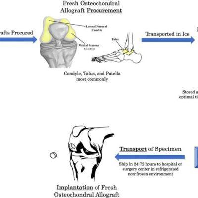  Osteochondral Allografts:  Bir İkinci Şans mı Yoksa Biyomalzeme Çağının Yeni Yıldızı mı?